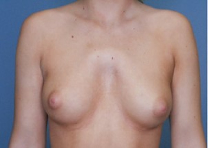 Breast Augmentation Before & After Gallery - Patient 83307257 - Image 1