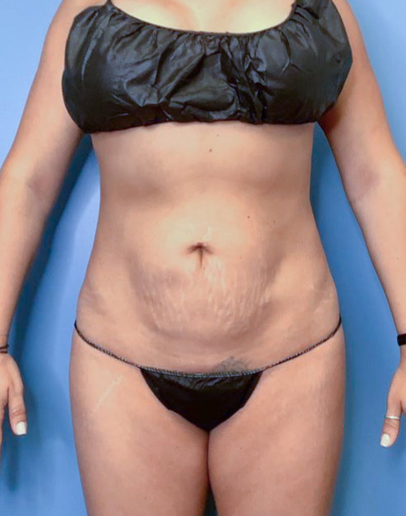 Tummy Tuck (Abdominoplasty)  Before & After Gallery - Patient 83317705 - Image 1
