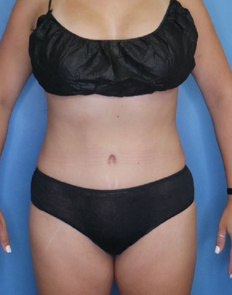 Tummy Tuck (Abdominoplasty)  Before & After Gallery - Patient 83317705 - Image 2