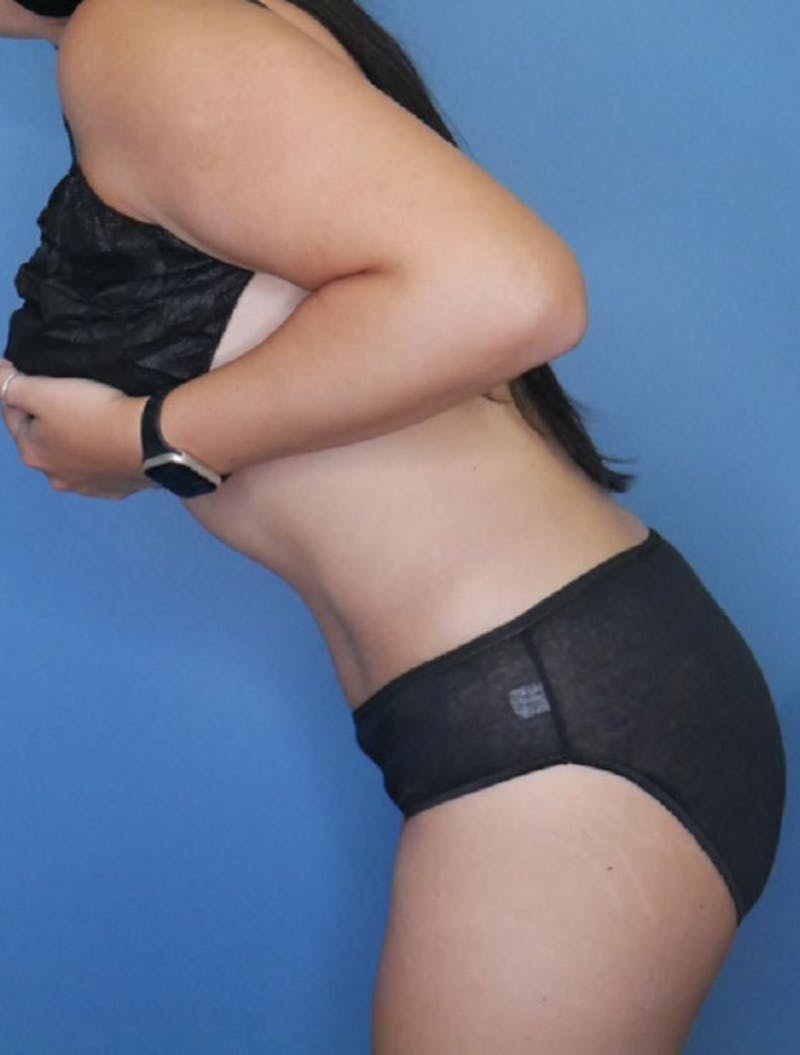 Tummy Tuck (Abdominoplasty)  Before & After Gallery - Patient 83317705 - Image 4