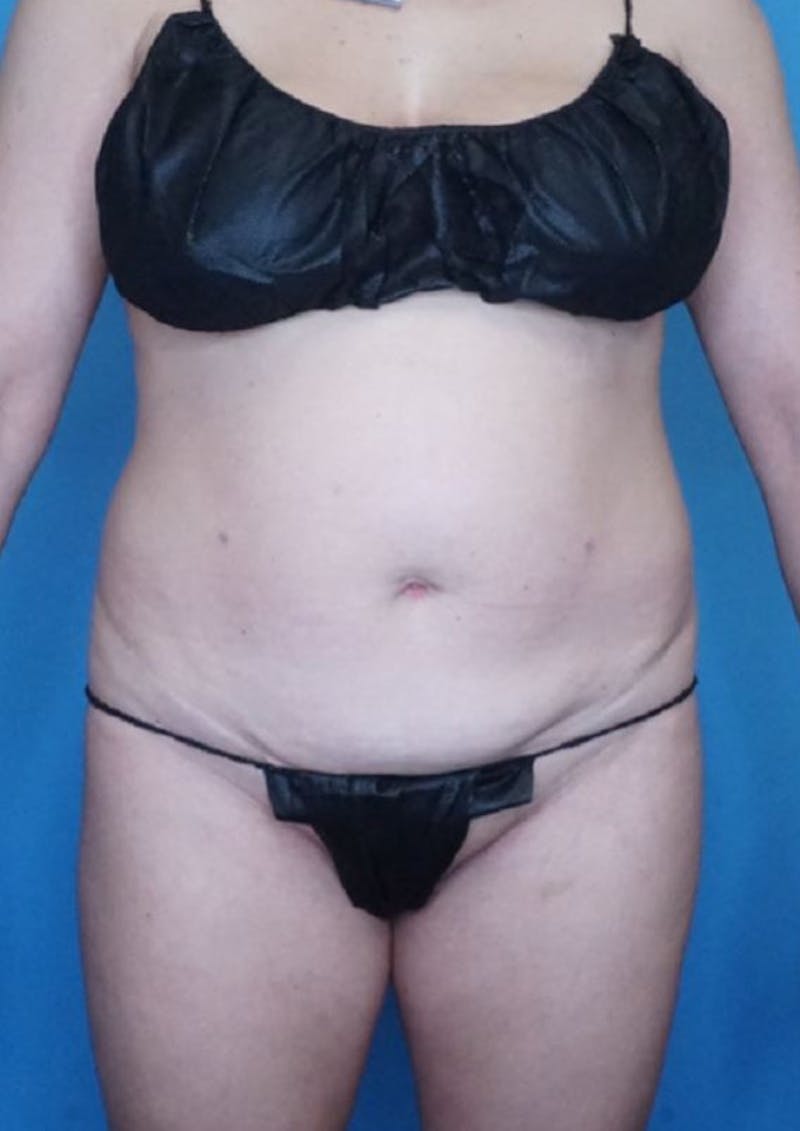 Tummy Tuck (Abdominoplasty)  Before & After Gallery - Patient 83369230 - Image 1