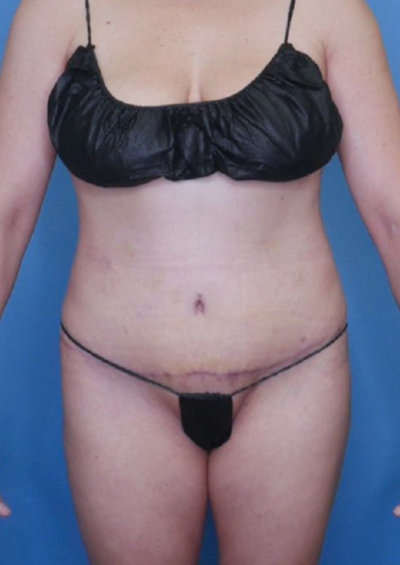 Tummy Tuck (Abdominoplasty)  Before & After Gallery - Patient 83369230 - Image 2