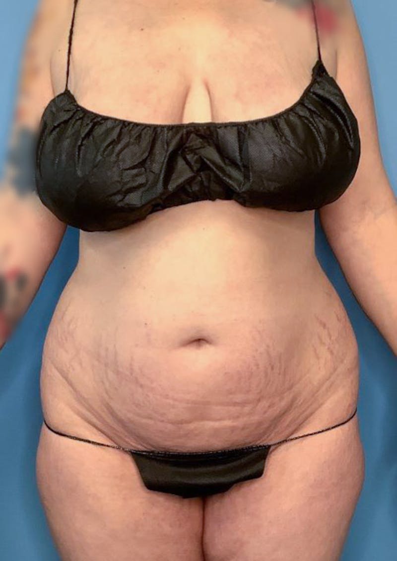 Vaser Liposuction Before & After Gallery - Patient 83594371 - Image 1