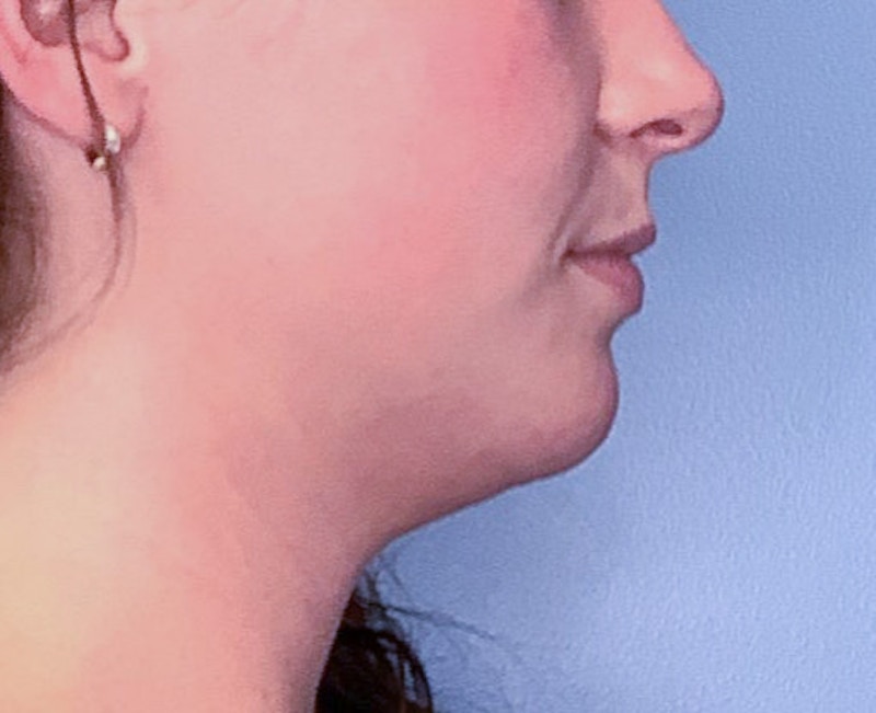Submental Liposuction Before & After Gallery - Patient 83594376 - Image 1