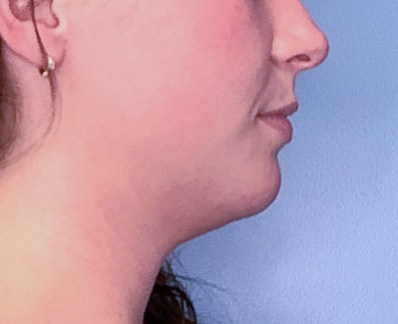 Submental (Chin) Liposuction Before & After Gallery - Patient 83594376 - Image 1