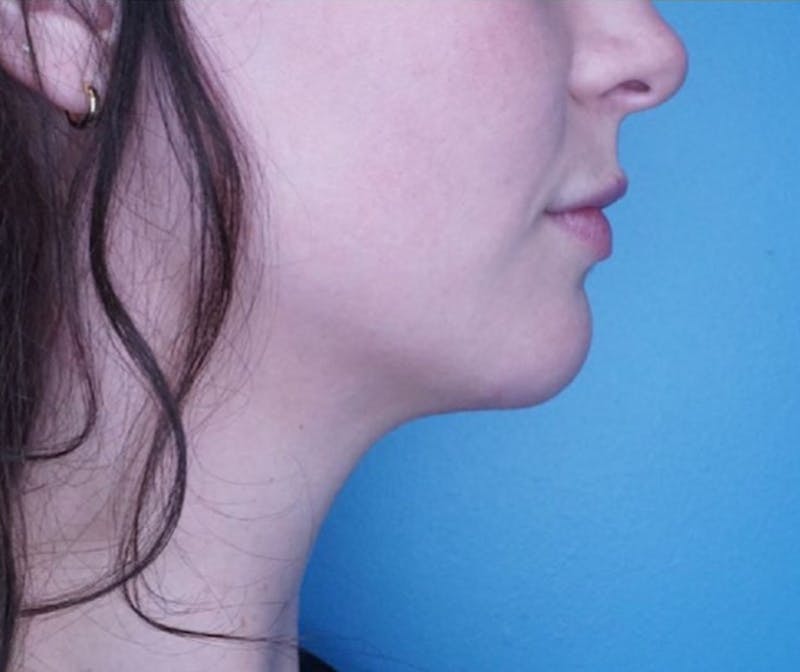 Submental (Chin) Liposuction Before & After Gallery - Patient 83594376 - Image 2