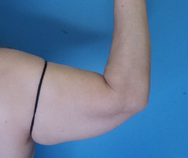 Arm Lift (Brachioplasty)  Before & After Gallery - Patient 83594388 - Image 1