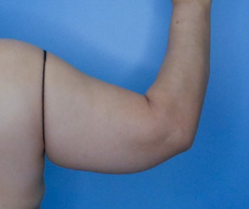 Arm Lift (Brachioplasty)  Before & After Gallery - Patient 83594388 - Image 2