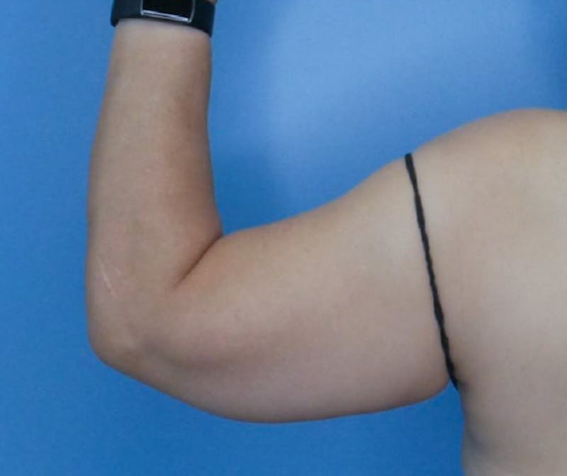 Arm Lift (Brachioplasty)  Before & After Gallery - Patient 83594388 - Image 3