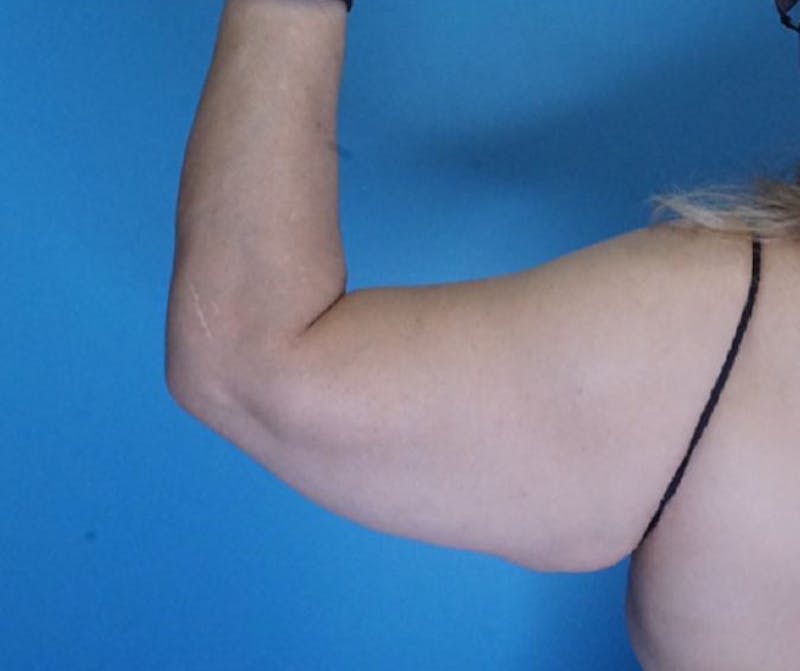 Arm Lift (Brachioplasty)  Before & After Gallery - Patient 83594388 - Image 4