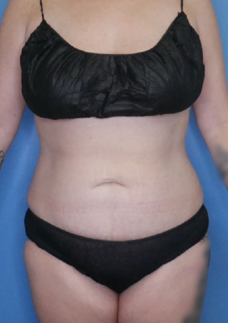 Mini Tummy Tuck Before & After Gallery - Patient 83594394 - Image 2