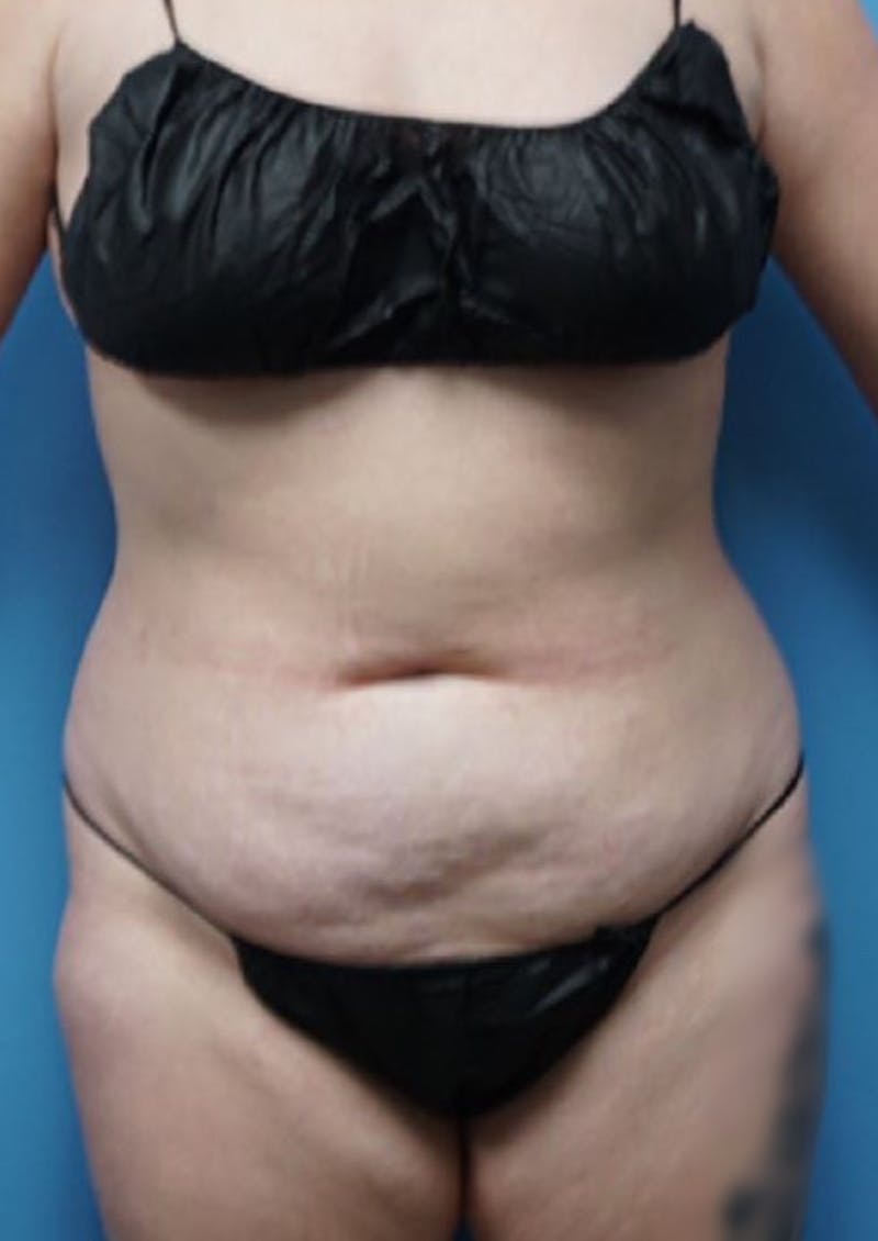 Mini Tummy Tuck Before & After Gallery - Patient 83594394 - Image 1