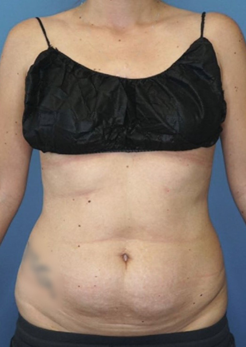 Mini Tummy Tuck Before & After Gallery - Patient 83594396 - Image 1