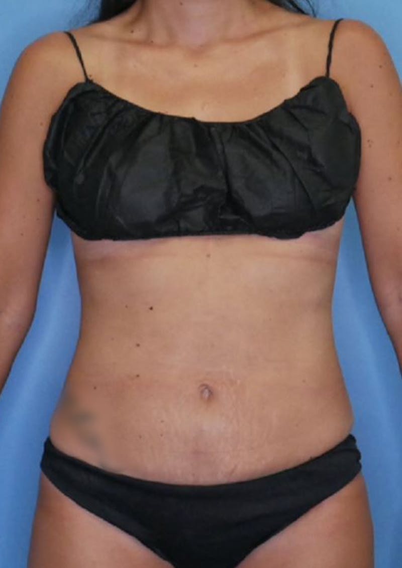 Mini Tummy Tuck Before & After Gallery - Patient 83594396 - Image 2