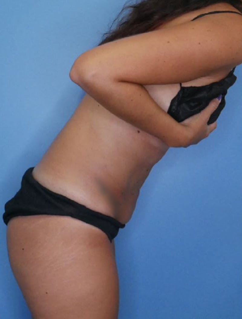 Mini Tummy Tuck Before & After Gallery - Patient 83594396 - Image 4