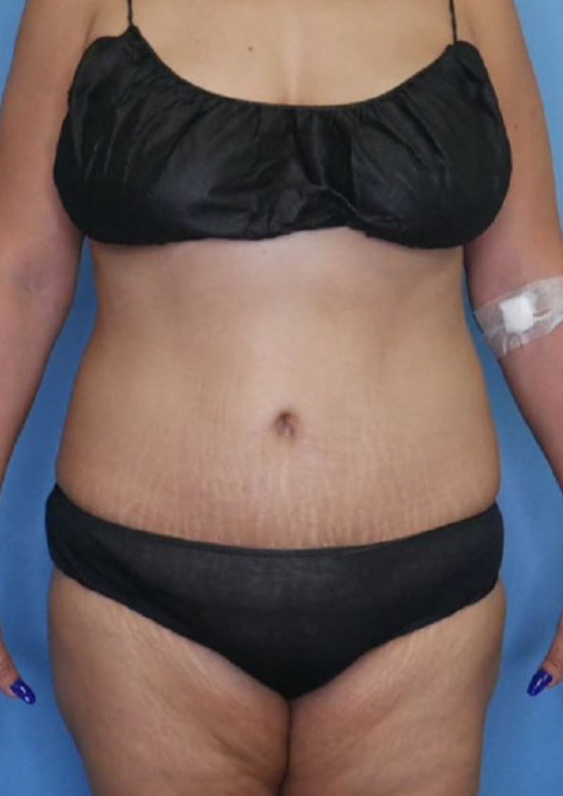 Mini Tummy Tuck Before & After Gallery - Patient 83594397 - Image 2