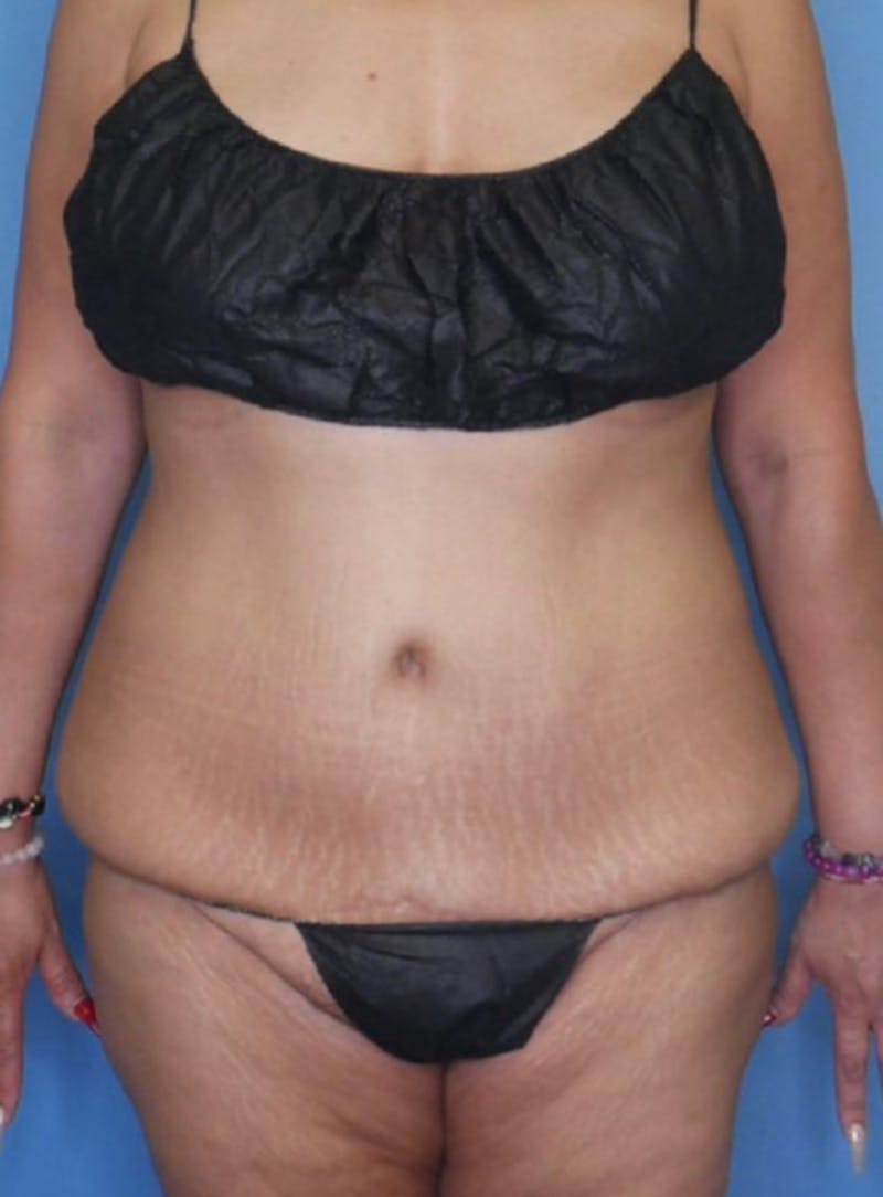 Mini Tummy Tuck Before & After Gallery - Patient 83594397 - Image 1