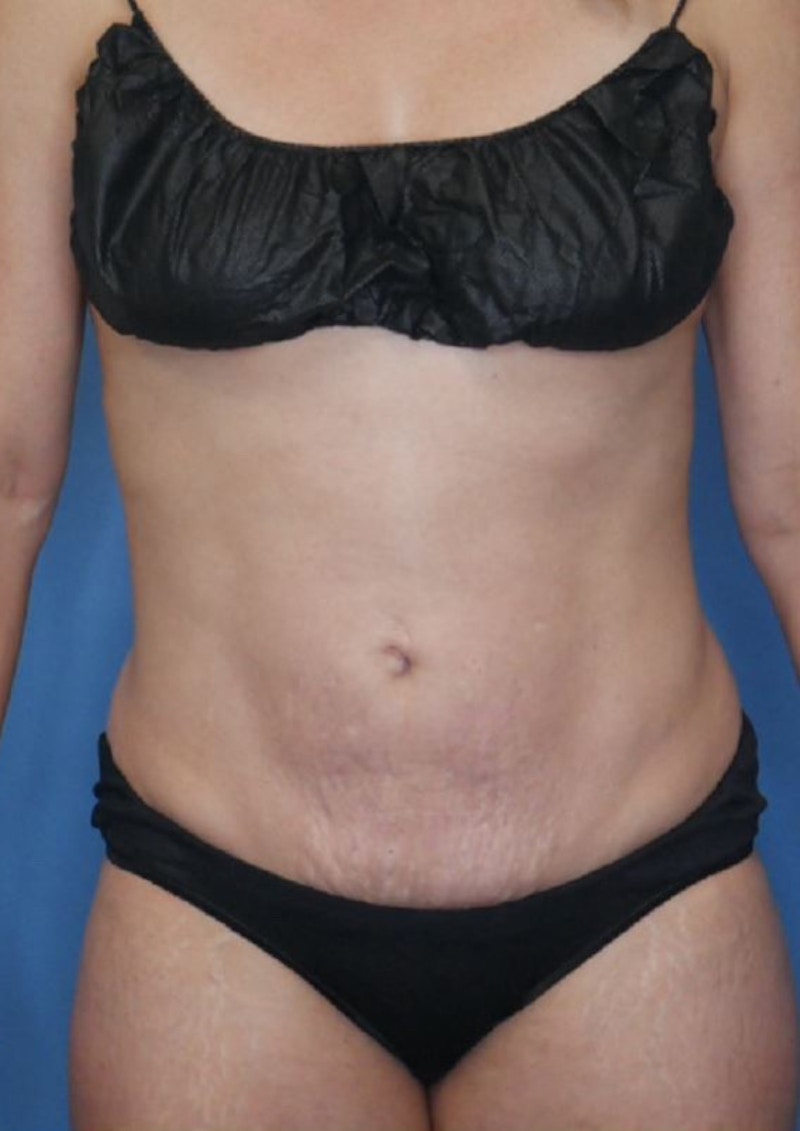 Mini Tummy Tuck Before & After Gallery - Patient 83594402 - Image 2