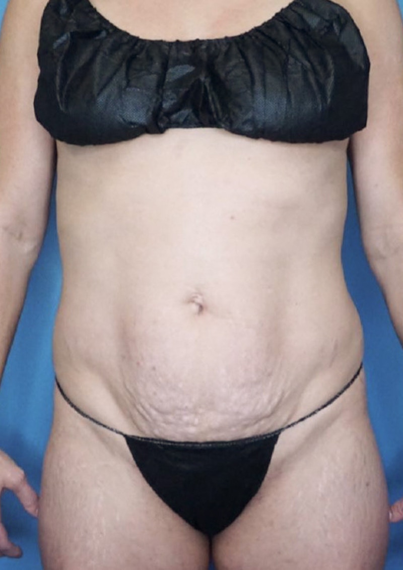 Mini Tummy Tuck Before & After Gallery - Patient 83594402 - Image 1