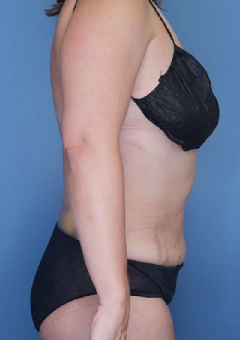 Tummy Tuck (Abdominoplasty)  Before & After Gallery - Patient 83594418 - Image 4