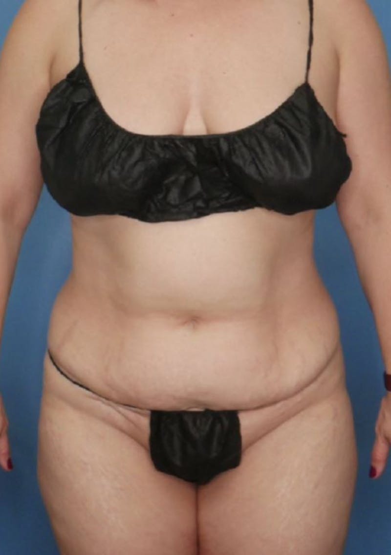 Tummy Tuck (Abdominoplasty)  Before & After Gallery - Patient 83594418 - Image 1