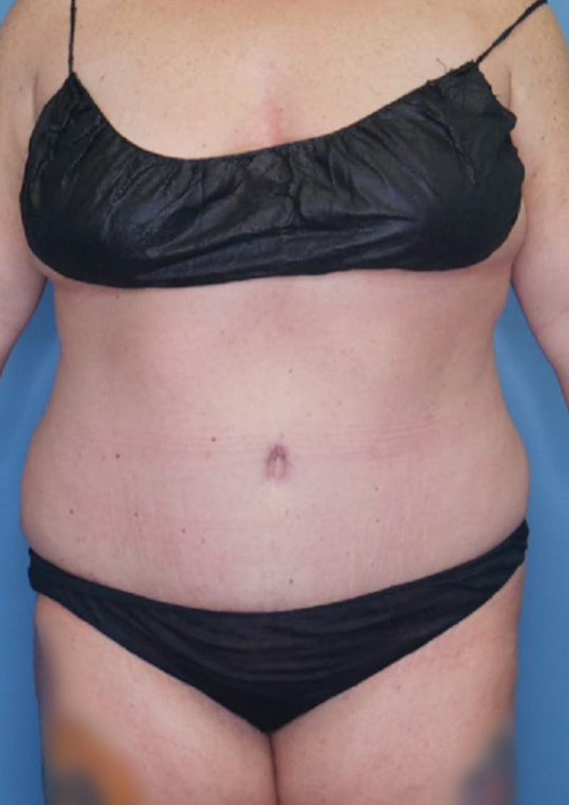 Tummy Tuck (Abdominoplasty)  Before & After Gallery - Patient 83594421 - Image 2