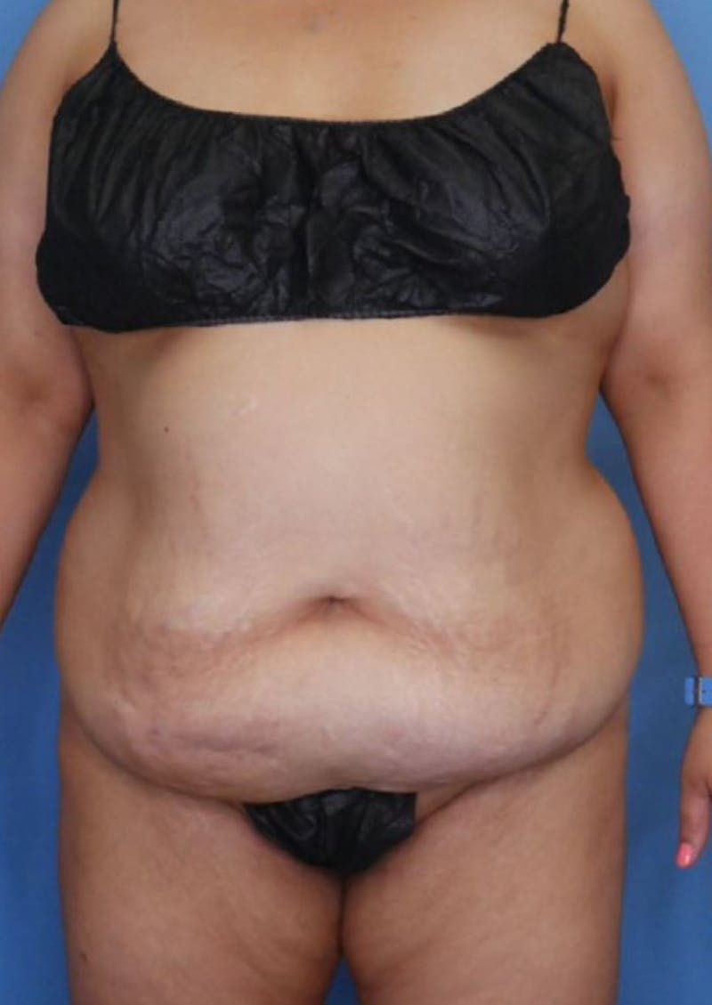 Tummy Tuck (Abdominoplasty)  Before & After Gallery - Patient 83594441 - Image 1