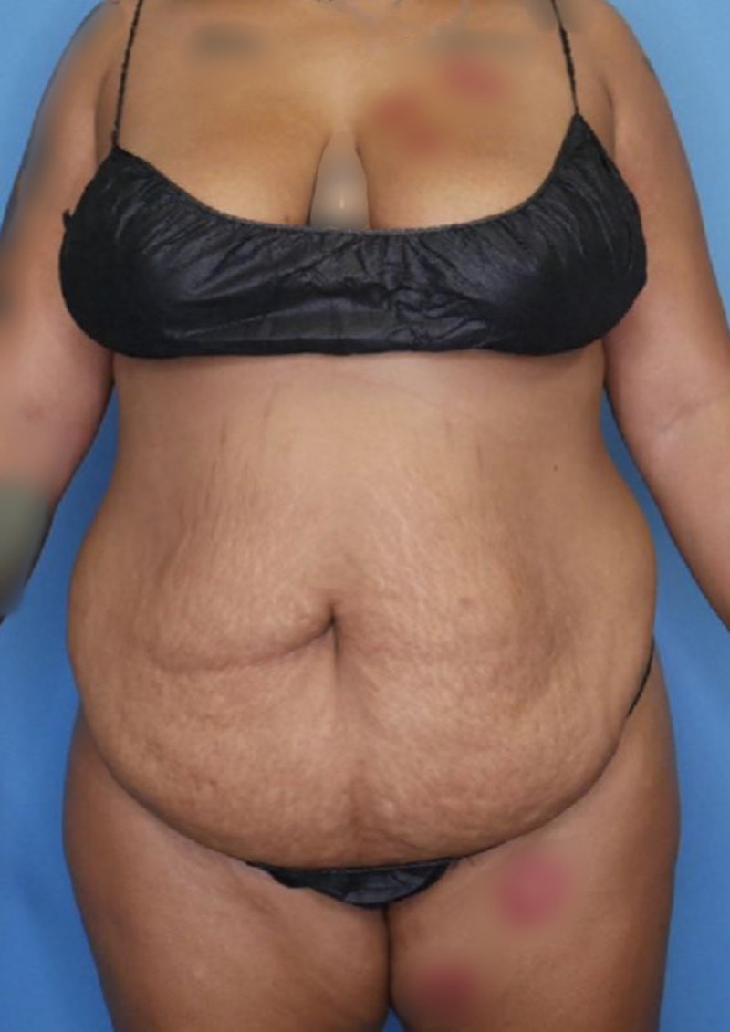 Tummy Tuck (Abdominoplasty)  Before & After Gallery - Patient 83594440 - Image 1