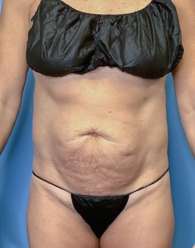 Tummy Tuck (Abdominoplasty)  Before & After Gallery - Patient 83594474 - Image 1