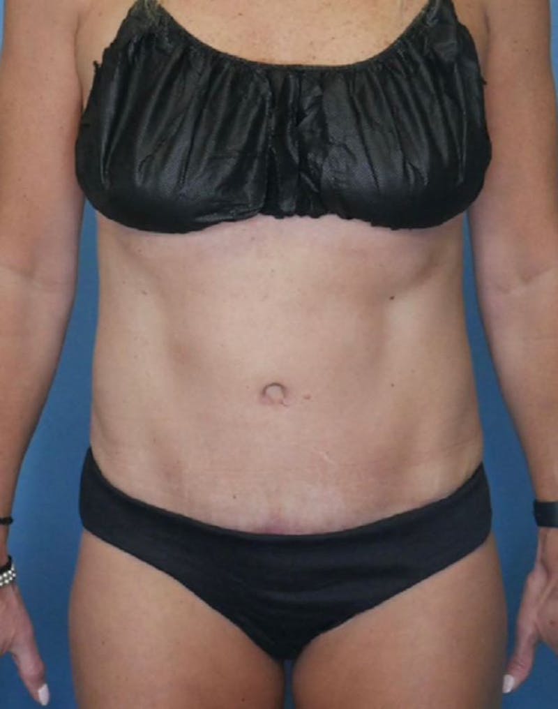 Tummy Tuck (Abdominoplasty)  Before & After Gallery - Patient 83594474 - Image 2