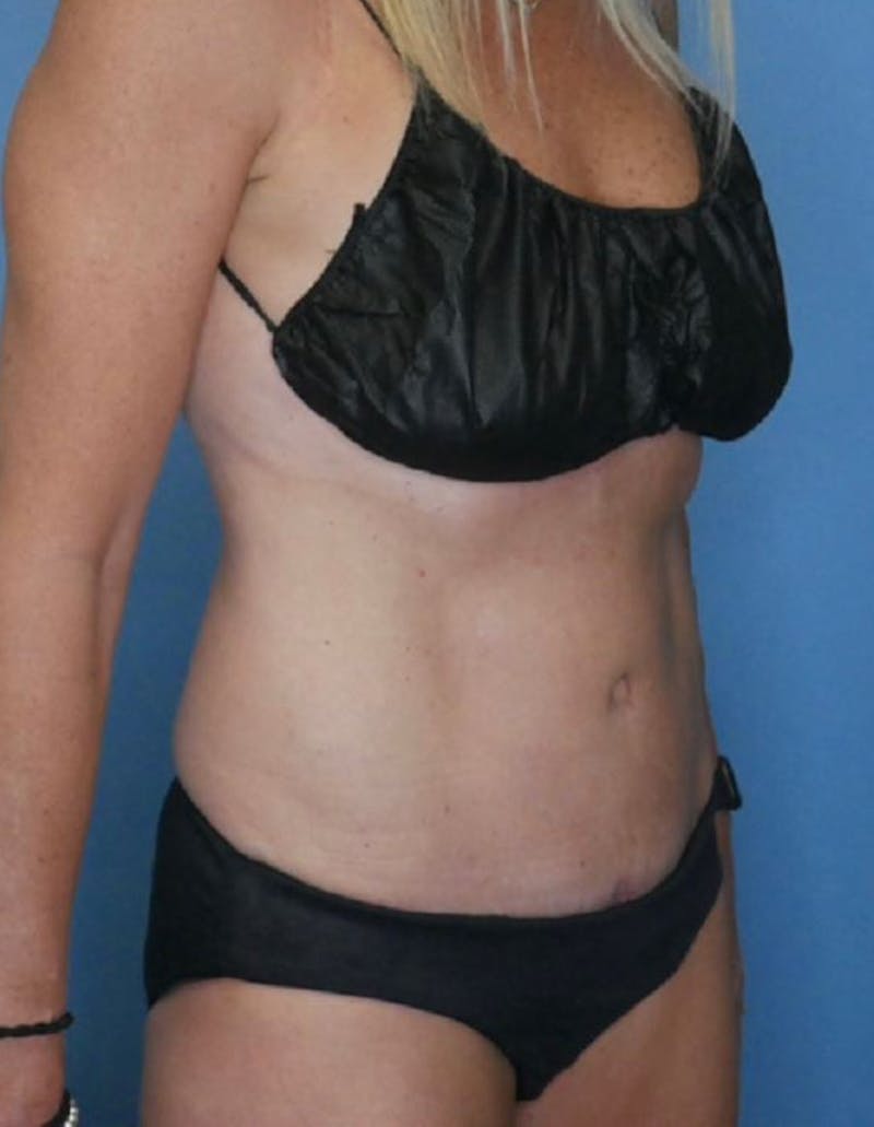 Tummy Tuck (Abdominoplasty)  Before & After Gallery - Patient 83594474 - Image 4