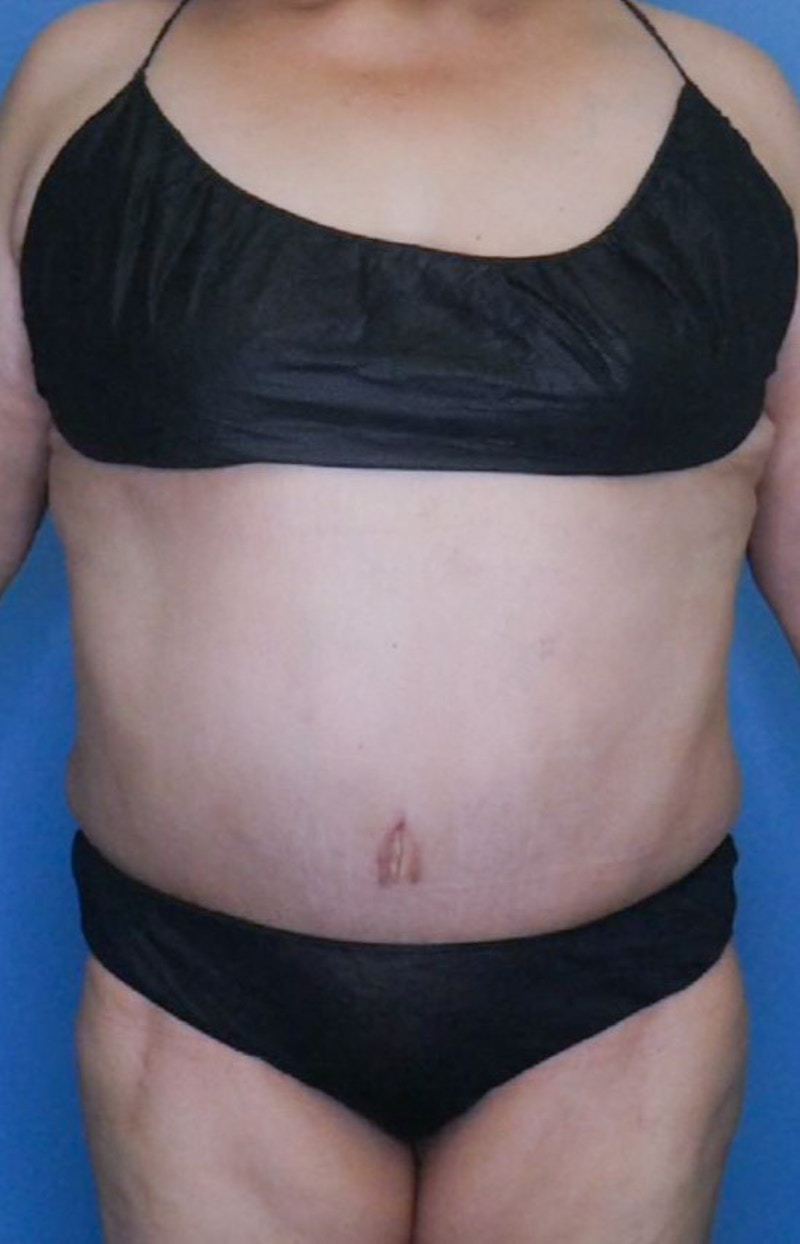 Tummy Tuck (Abdominoplasty)  Before & After Gallery - Patient 83594476 - Image 2