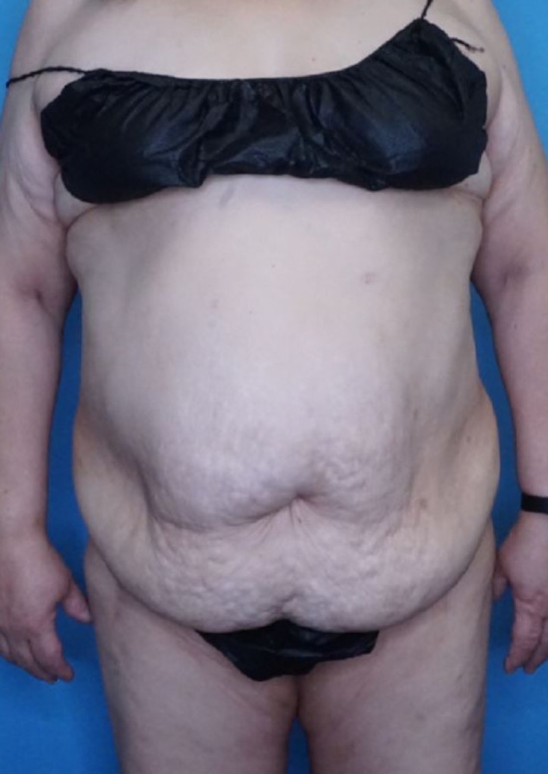 Tummy Tuck (Abdominoplasty)  Before & After Gallery - Patient 83594476 - Image 1