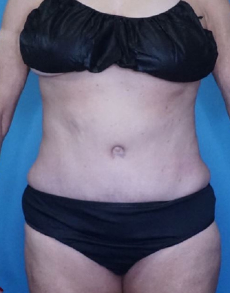 Tummy Tuck (Abdominoplasty)  Before & After Gallery - Patient 83597549 - Image 2