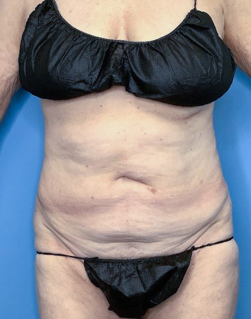 Tummy Tuck (Abdominoplasty)  Before & After Gallery - Patient 83597549 - Image 1