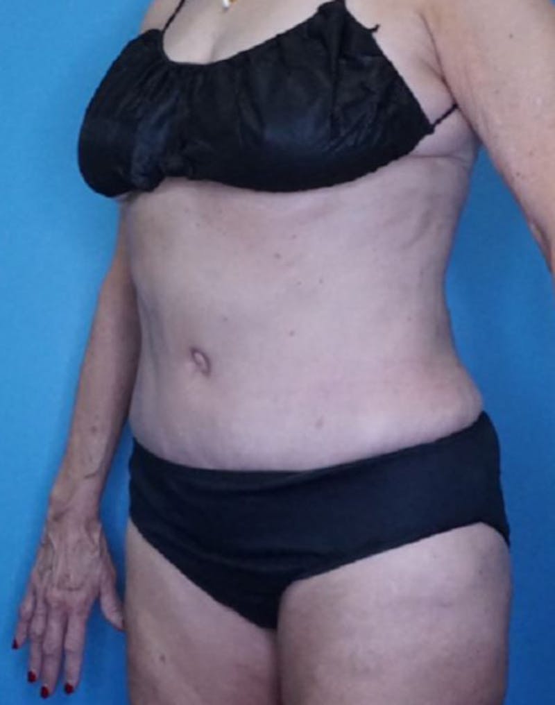 Tummy Tuck (Abdominoplasty)  Before & After Gallery - Patient 83597549 - Image 4