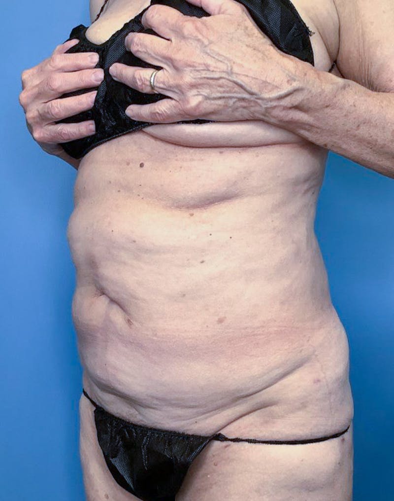 Tummy Tuck (Abdominoplasty)  Before & After Gallery - Patient 83597549 - Image 3