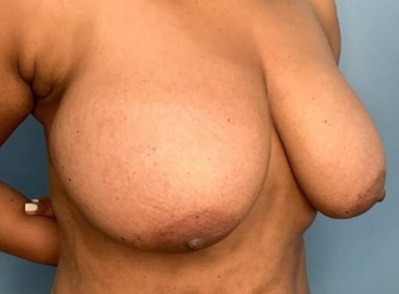 Breast Reduction Before & After Gallery - Patient 83597564 - Image 1