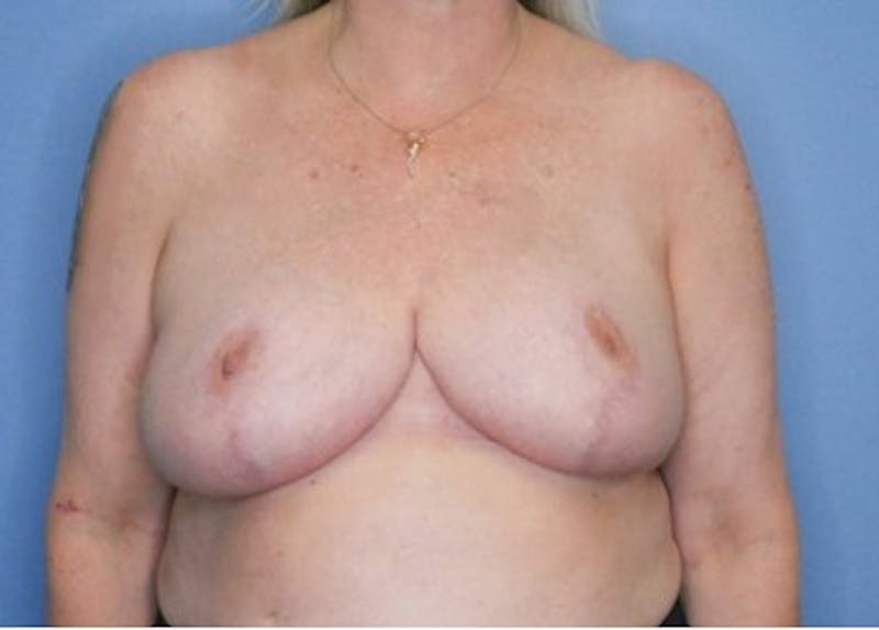 Breast Reduction Before & After Gallery - Patient 83597577 - Image 2