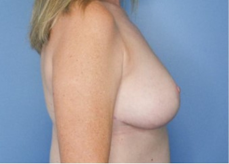 Breast Lift Before & After Gallery - Patient 83597605 - Image 2