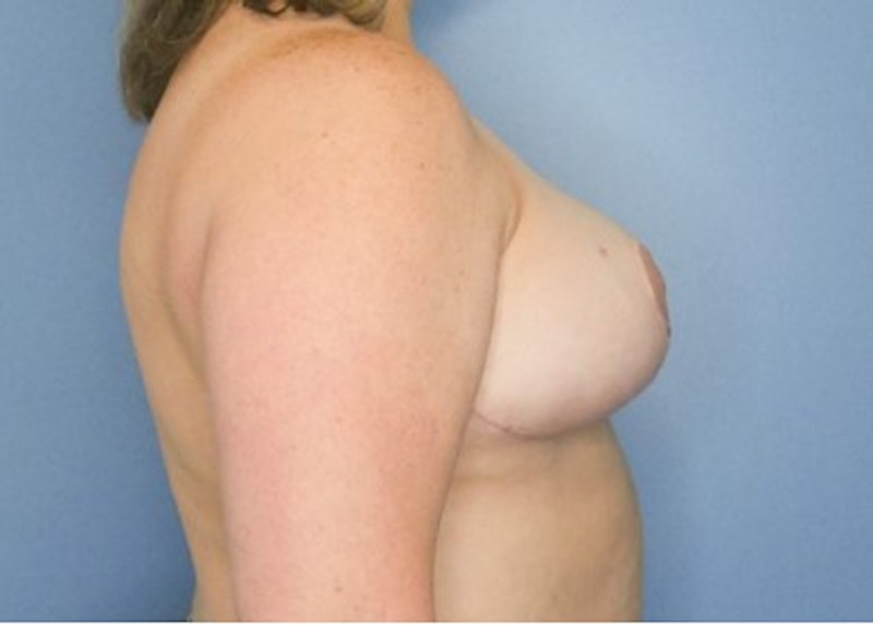 Breast Lift Before & After Gallery - Patient 83822977 - Image 2
