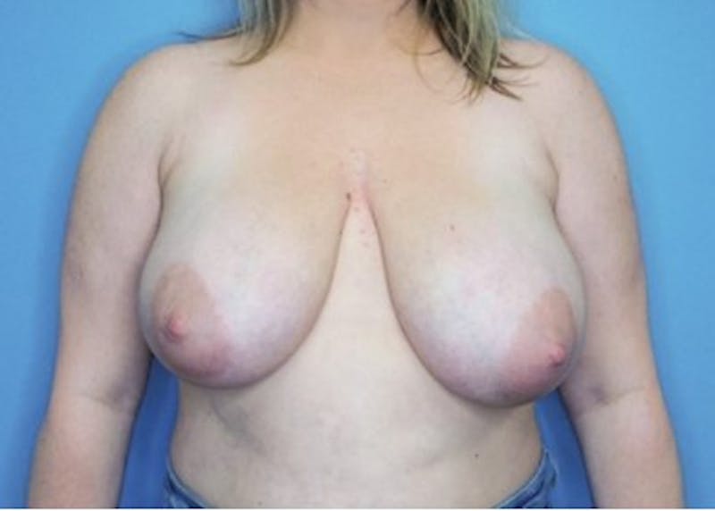 Breast Lift Before & After Gallery - Patient 83822977 - Image 3