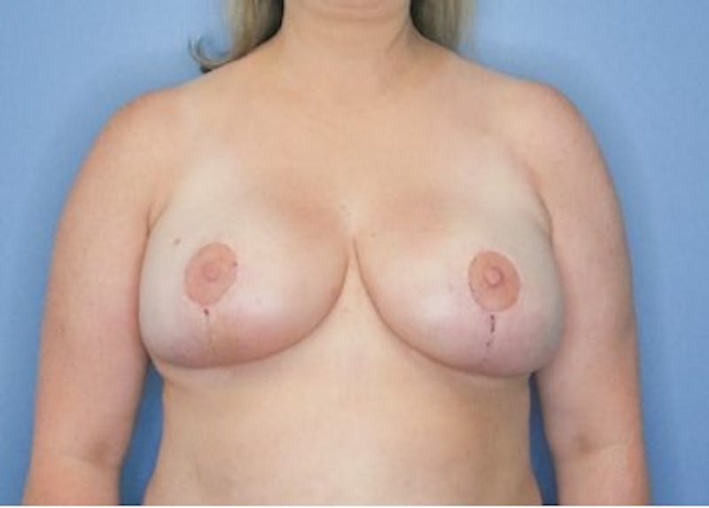 Breast Lift Before & After Gallery - Patient 83822977 - Image 4