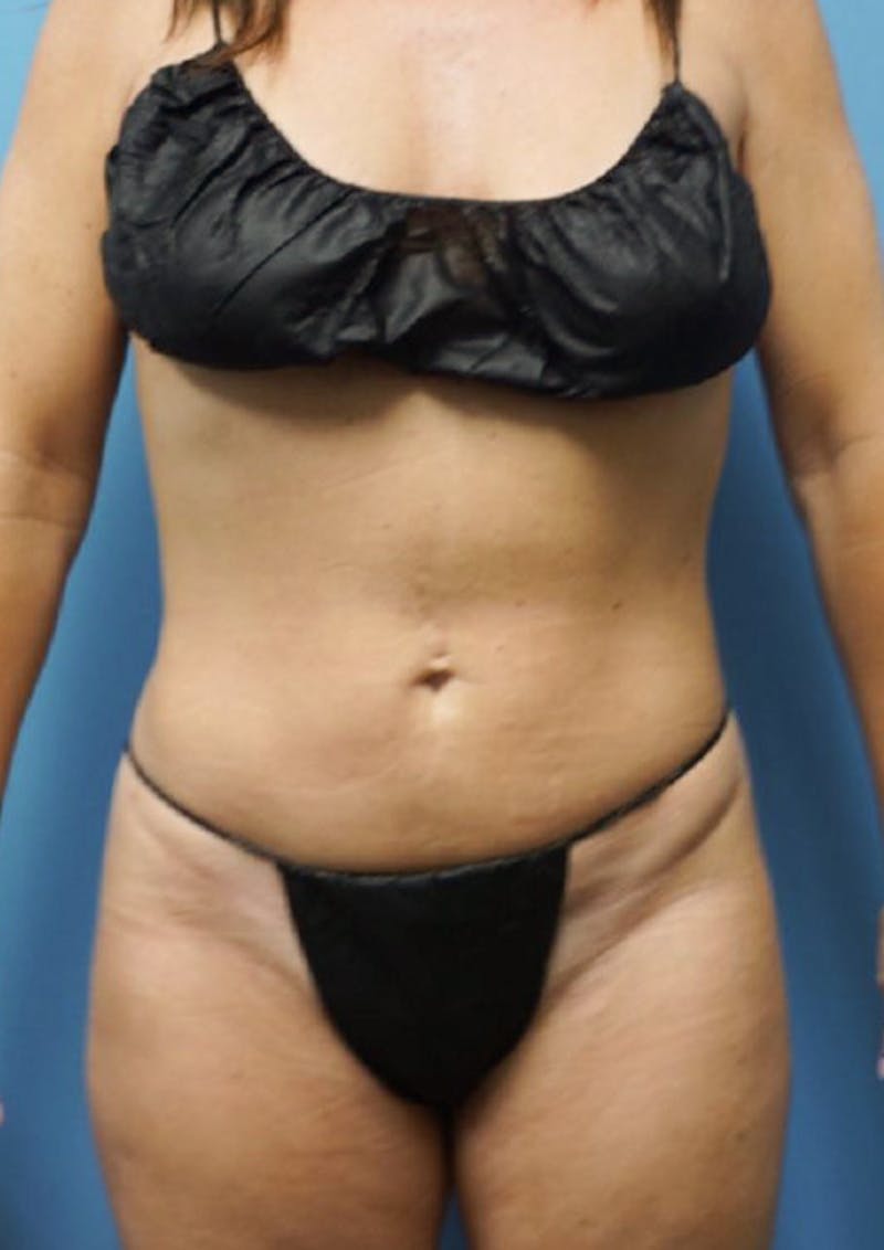 Vaser Liposuction Before & After Gallery - Patient 86645062 - Image 2