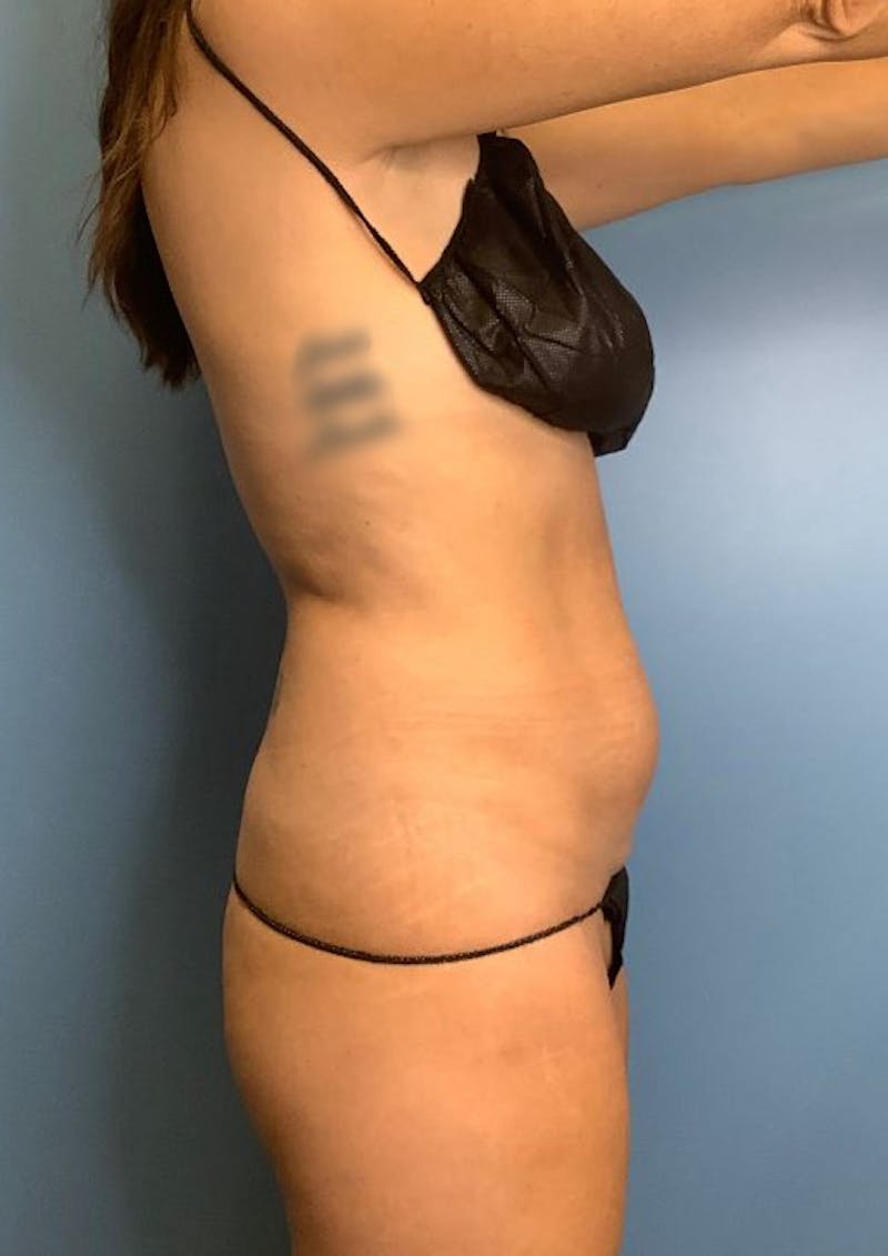 Vaser Liposuction Before & After Gallery - Patient 86645062 - Image 3