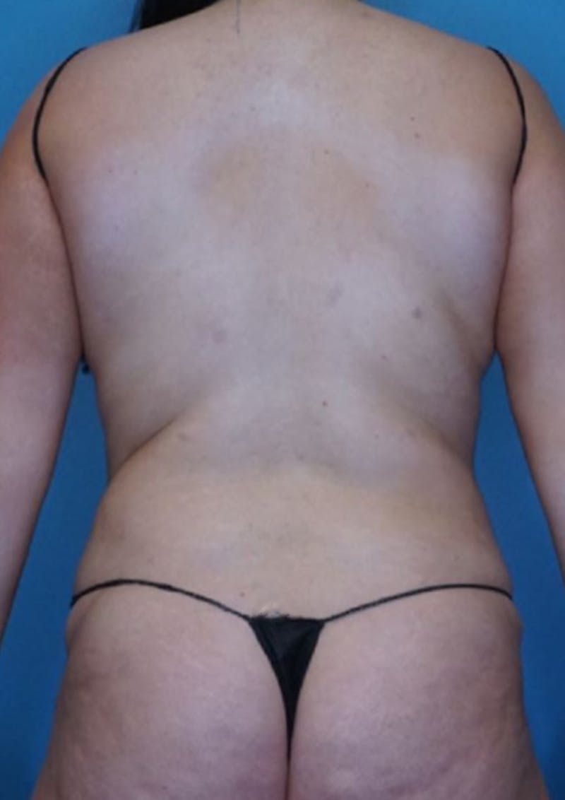 Vaser Liposuction Before & After Gallery - Patient 86645064 - Image 1