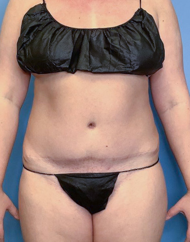 Vaser Liposuction Before & After Gallery - Patient 86645068 - Image 1