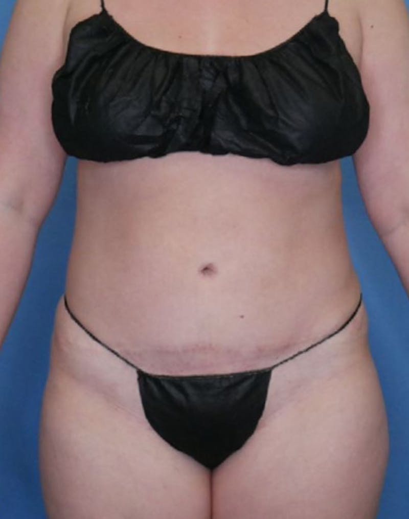 Vaser Liposuction Before & After Gallery - Patient 86645068 - Image 2