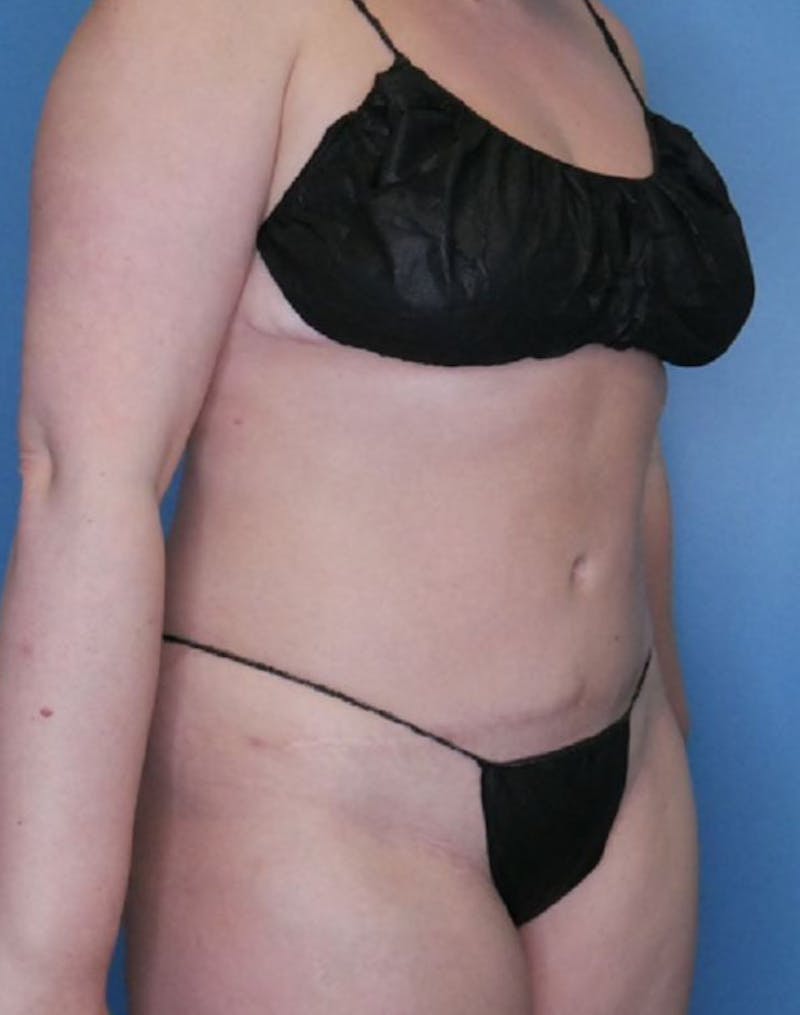 Vaser Liposuction Before & After Gallery - Patient 86645068 - Image 4