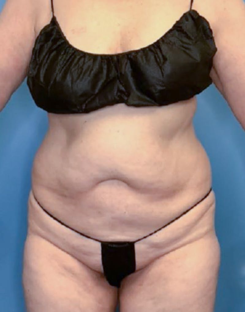 Vaser Liposuction Before & After Gallery - Patient 86645071 - Image 1